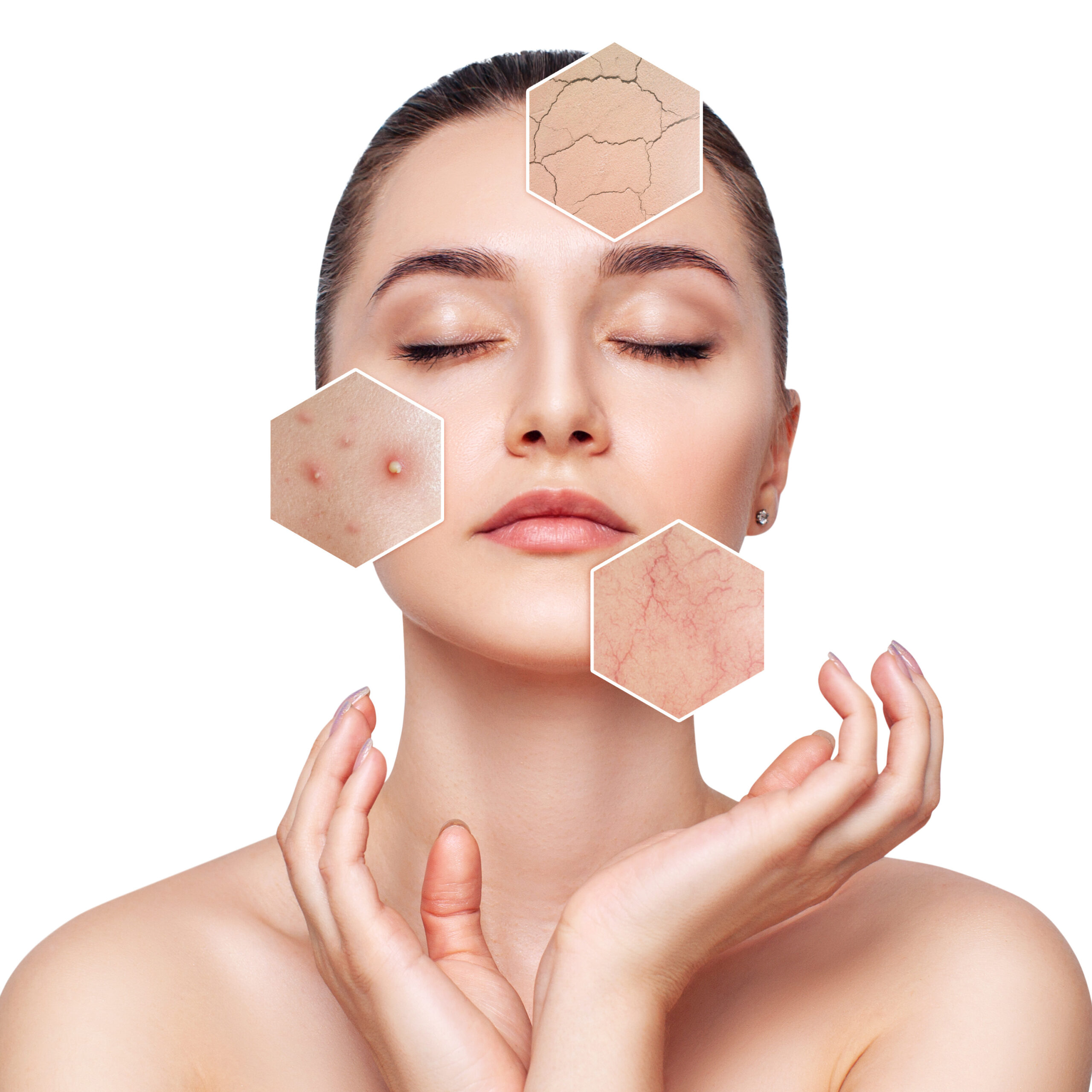 Young woman with couperose and acne on face skin. Zoom hexagon shows skin problems. Isolated on white.