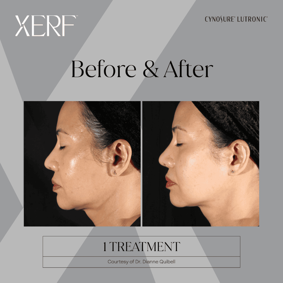 After 2 XERF treatments