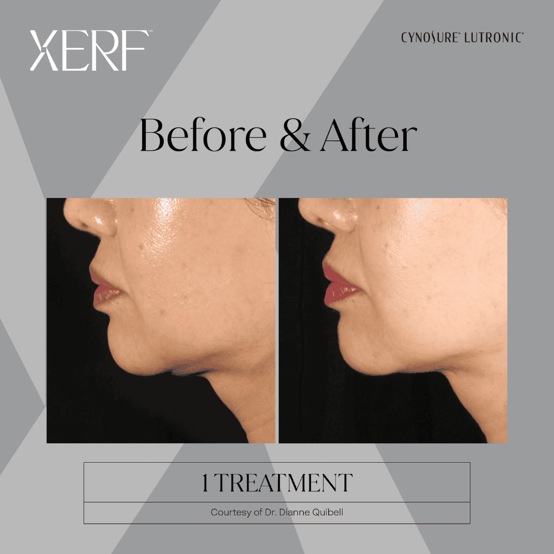 Before XERF treatment